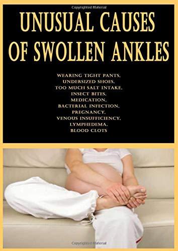 Unusual Causes of Swollen Ankles: Wearing Tight Pants, Undersized Shoes, Too Much Salt Intake, Insect Bites, Medication, Bacterial Infection, Pregnancy, Venous Insufficiency, Lymphedema, Blood Clots