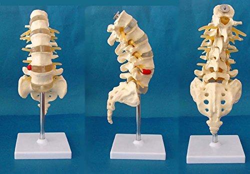 Medical Human Spine Spine Pathology Demonstration Model Anatomical Model Lumbar Vertebrae Sacrum & Coccyx, with Herniation Disc Sold by East dental